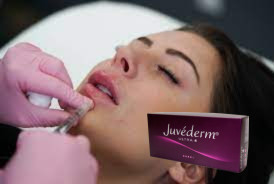 หญิง Hyaluronic Acid ผิวหนังครอบคลุม Juvederm จีบครอบคลุม Ultra 3 Ultra 4