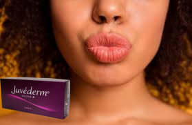 Juvederm Ultra 3 ไฮยอลูรอนิกแอซิด HA Dermal Filler 2ml การเสริมริมฝีปาก