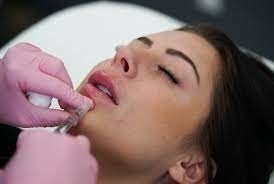 GMP Juvederm Ultra 3 HA Dermal Filler สําหรับริมฝีปาก Juvederm Vollure